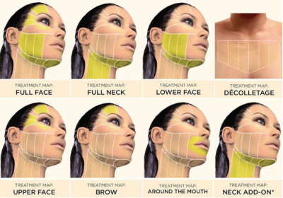 HIFU treatment at Maison Montclair