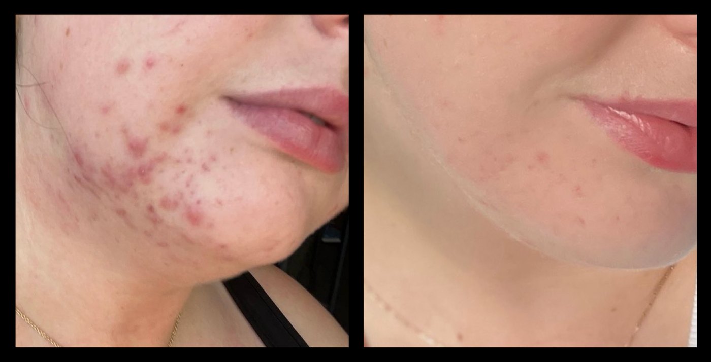 MediLUX LED before and after