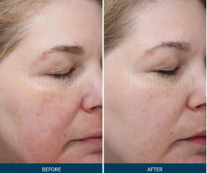 skinpen microneedling at Maison Montclair