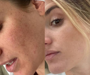 skinpen microneedling at Maison Montclair
