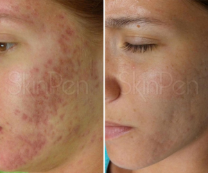 skinpen microneedling at Maison Montclair