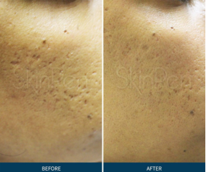 skinpen microneedling at Maison Montclair