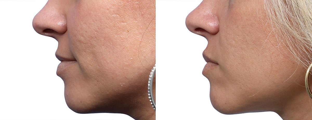 SkinPen microneedling before and after