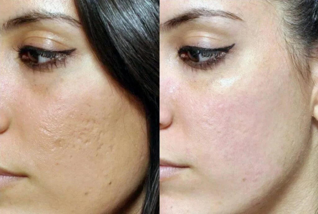 SkinPen microneedling before and after