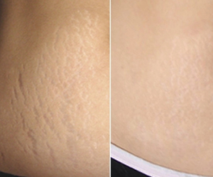 skinpen microneedling at Maison Montclair
