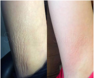 skinpen microneedling at Maison Montclair