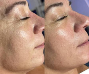 skinpen microneedling at Maison Montclair