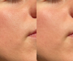 skinpen microneedling at Maison Montclair
