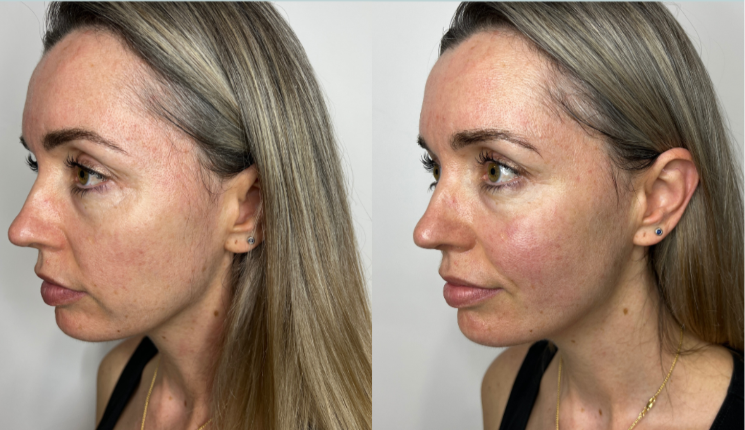 Ulfit HIFU results before and after at Maison Montclair