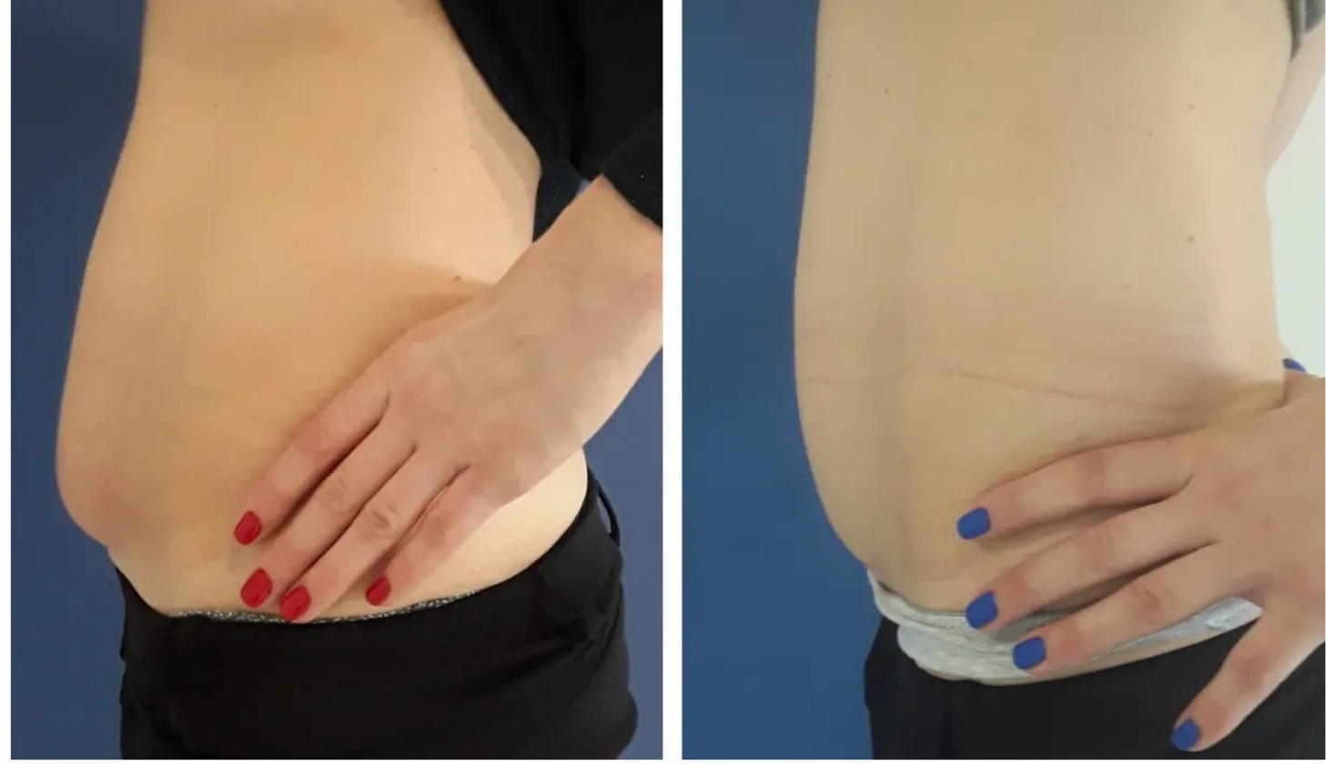 Ulfit HIFU jowl lift before and after at Maison Montclair