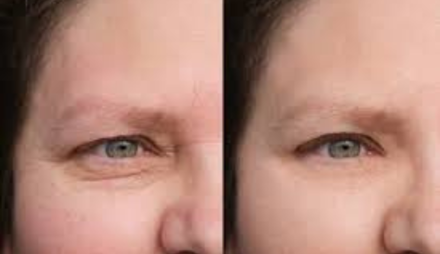 Ulfit HIFU jowl lift before and after at Maison Montclair