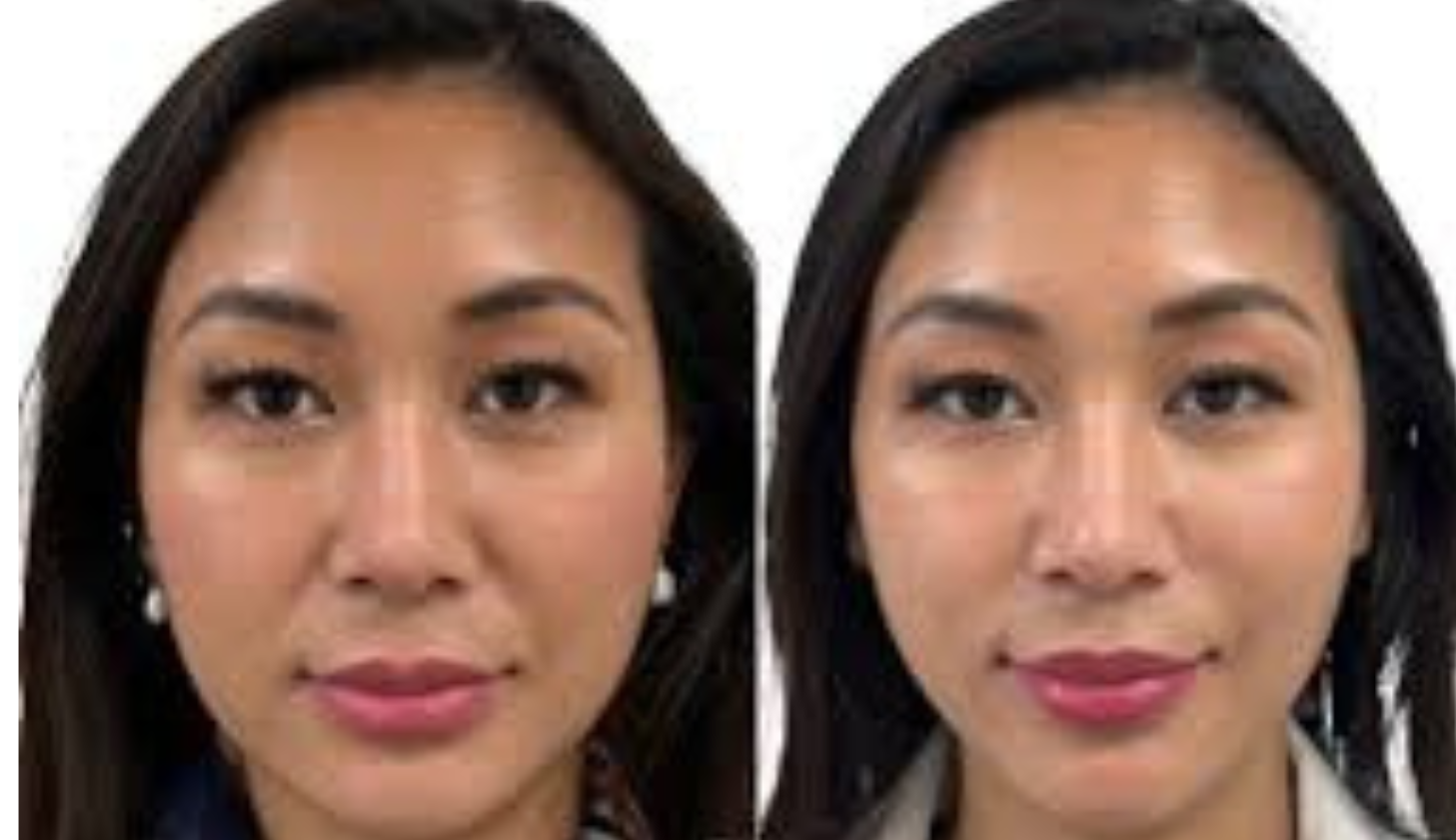 Ulfit HIFU jowl lift before and after at Maison Montclair