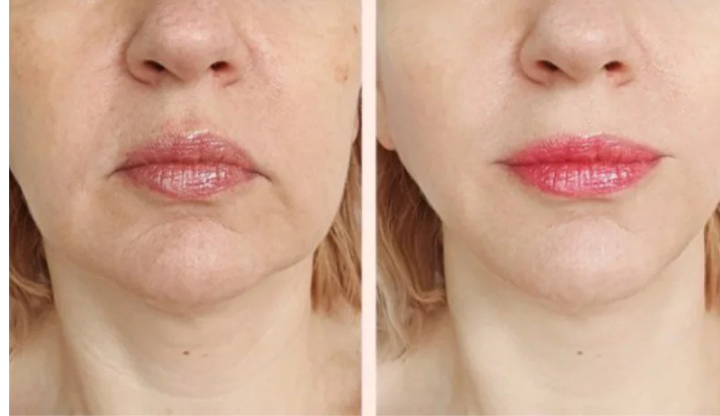 Ulfit HIFU jowl lift before and after at Maison Montclair