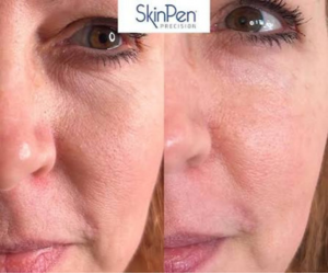skinpen microneedling at Maison Montclair