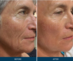 skinpen microneedling at Maison Montclair